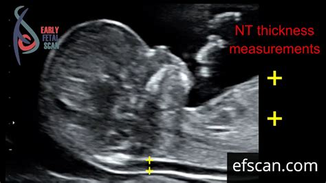 nuchal fold thickness measurement at 14 weeks|measuring nuchal fold on ultrasound.